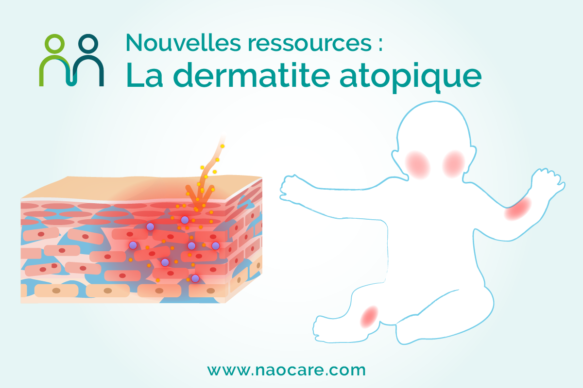 La dermatite atopique